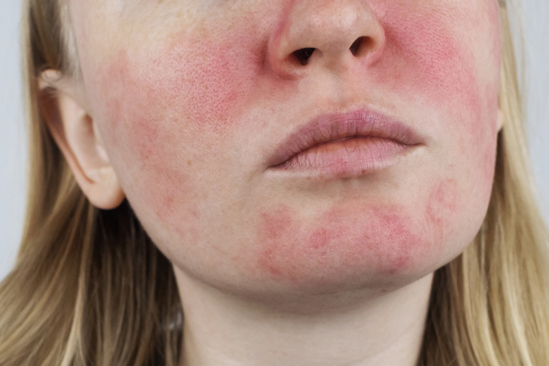 La rosacea: cos’è, quali sono le cause e come affrontarla