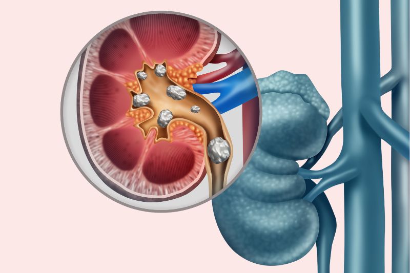 Calcoli renali: cosa sono, come si manifestano e come prevenirli