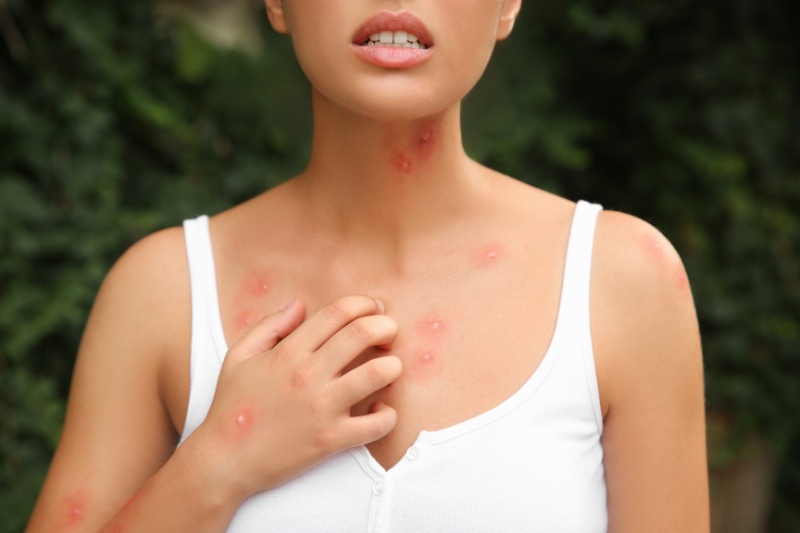 Punture di insetto: come riconoscerle, trattarle e prevenirle