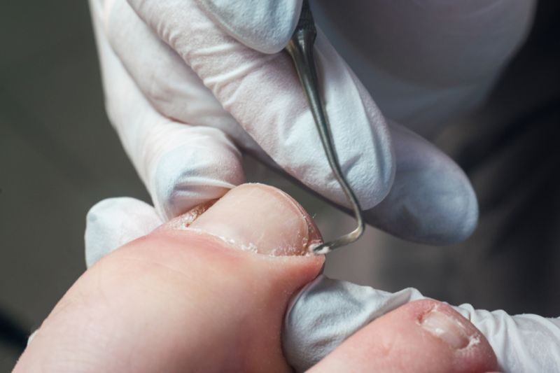 Unghia incarnita: come riconoscerla, prevenirla e trattarla correttamente