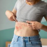 orticaria
