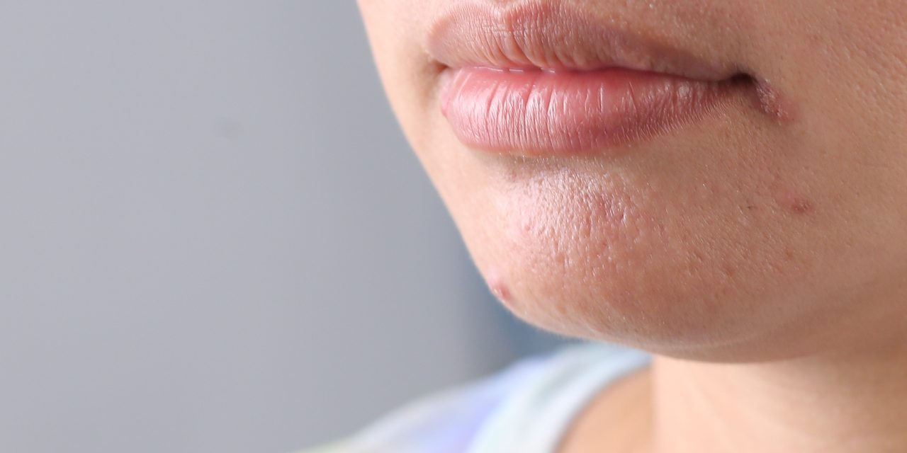 Cheilite angolare: cause frequenti e prodotti utilizzati localmente